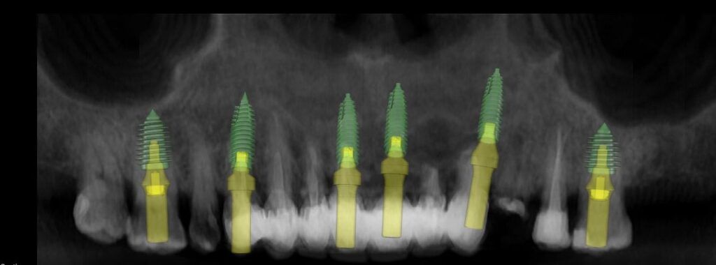 Panoramic CBCT reconstruction of the maxilla with six implants planned at 17, 15, 11, 21, 23 and 27