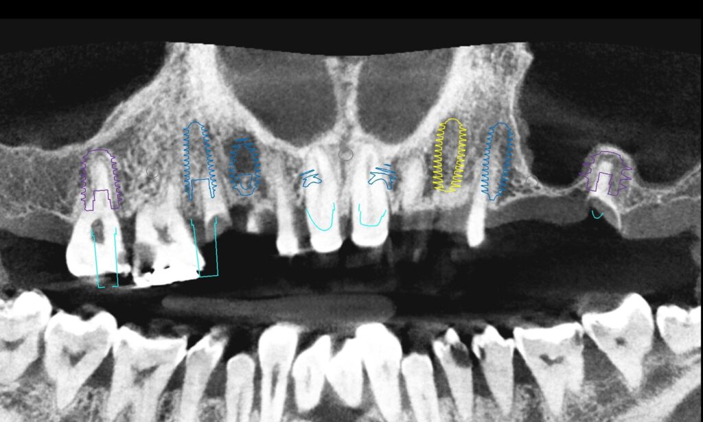 Panoramic CBCT reconstruction of the maxilla with eight implants planned across the arch
