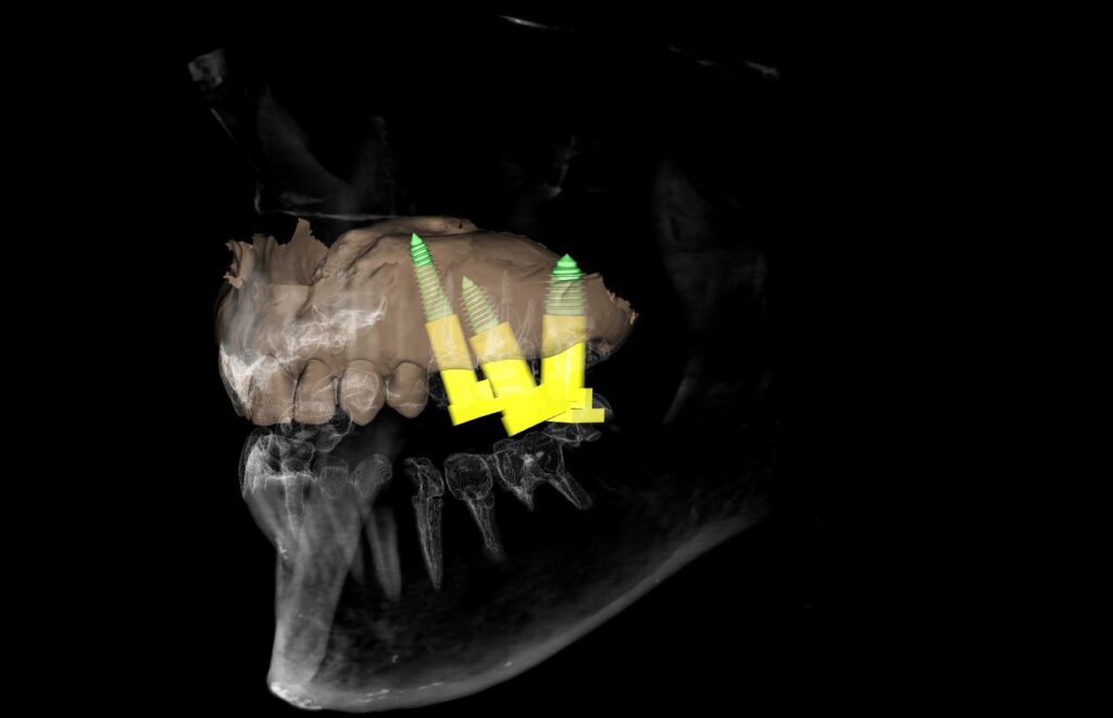 Three-dimensional reconstruction showing three tilted implants at 25, 26 and 27 with angulated multi-unit abutments
