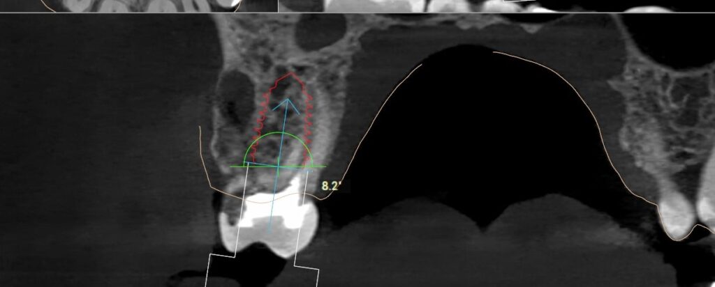 CBCT cross-section at site 16 with a 6.0 by 10 mm implant planned into the septum below the maxillary sinus