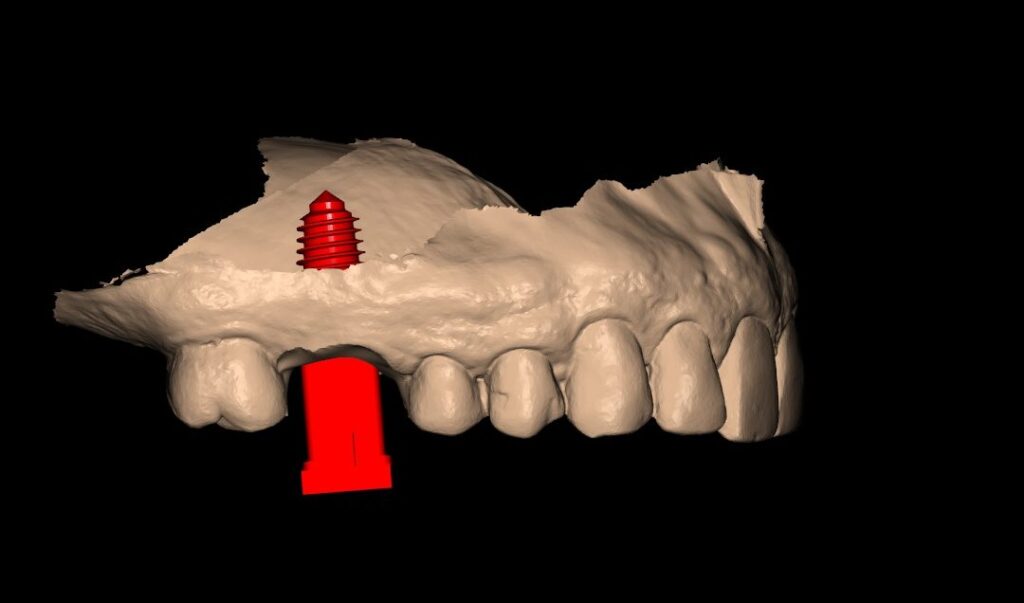 Three-dimensional plan view of the implant at site 16 with the patient-specific healing abutment designed beneath it