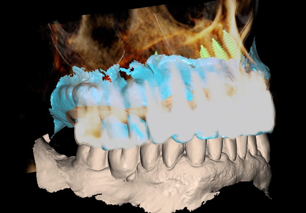 Three-dimensional SMOP plan combining the CBCT volume, the surface scan and the planned prosthetic design