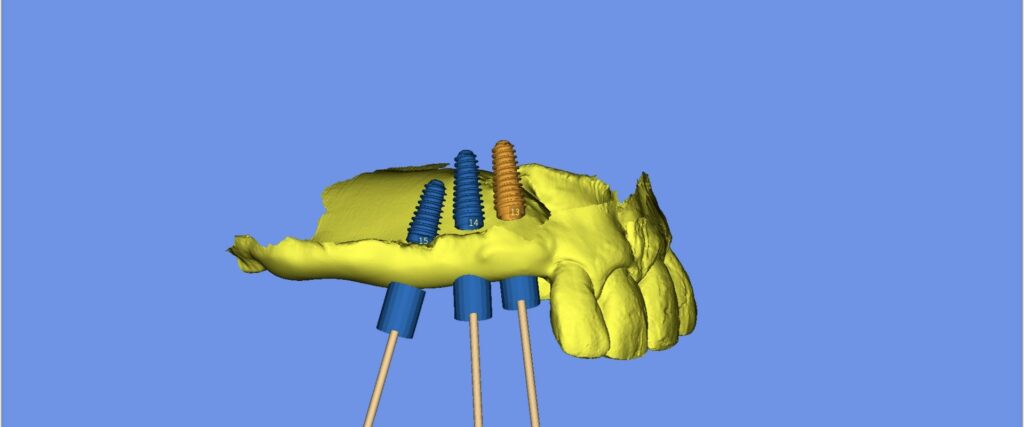 Three-dimensional SMOP view of the planned implants at sites 13, 14 and 15 with the printed template