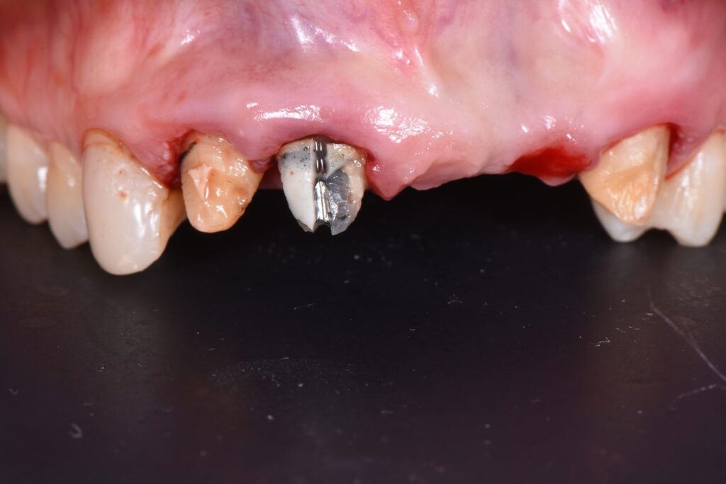 Intraoral view of the anterior maxilla before surgery, showing the edentulous span at 21 and 22