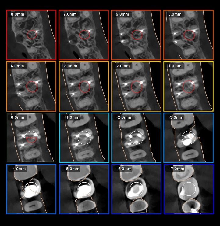 Serial axial CBCT sections through the upper first molar showing the roots and the interradicular septum