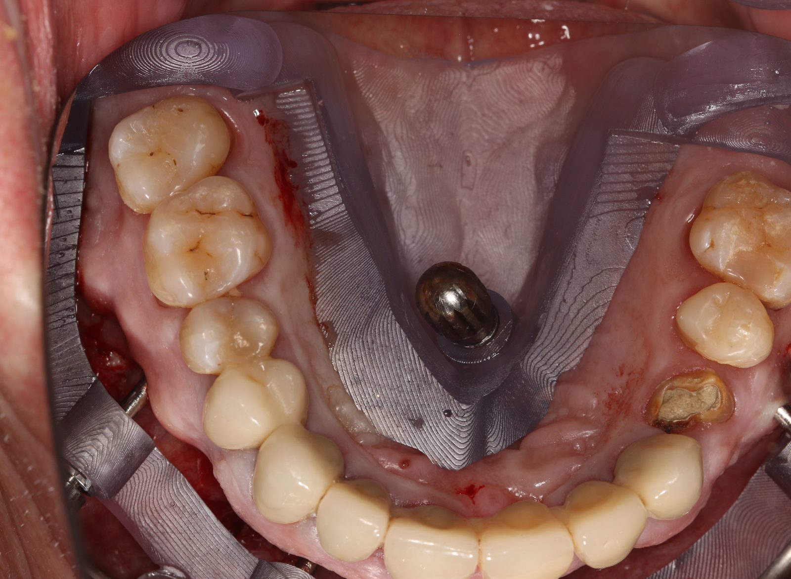 The stackable base guide seated over the standing maxillary teeth with its fixation ball visible
