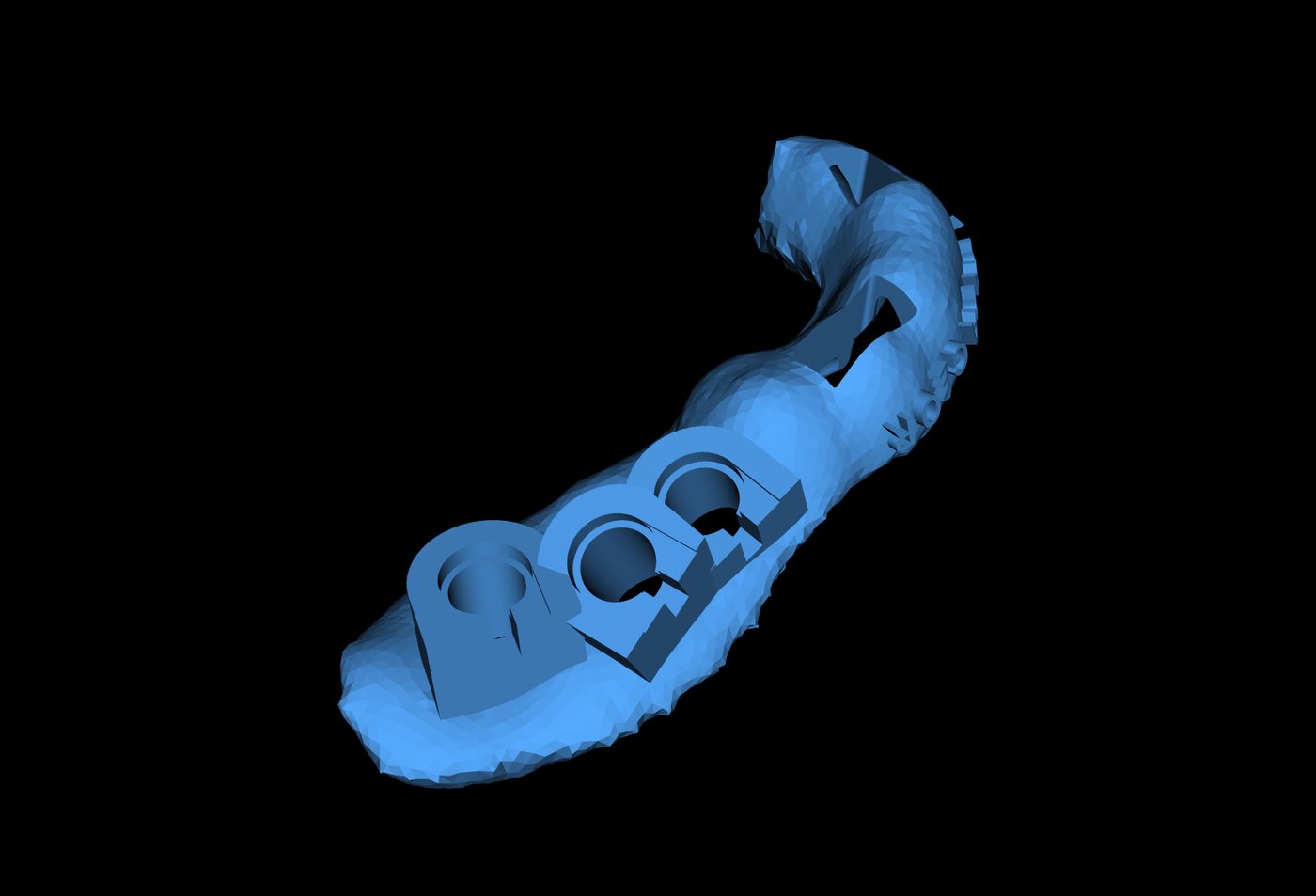 The designed surgical template for sites 25, 26 and 27