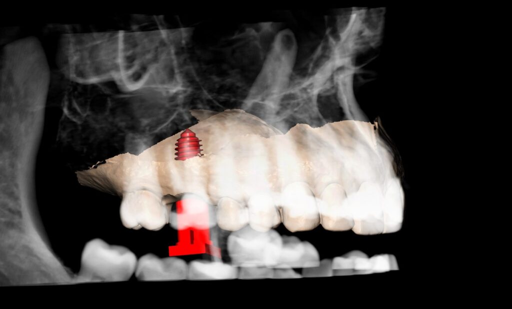Three-dimensional reconstruction of the maxilla with the planned implant and healing abutment at site 16