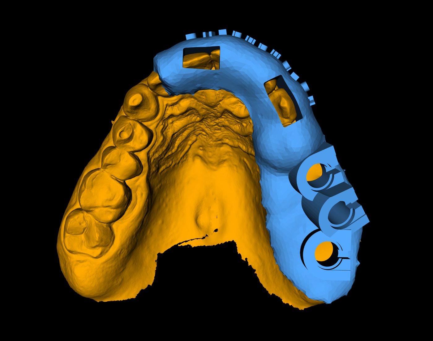 The template seated on the digital model of the upper arch