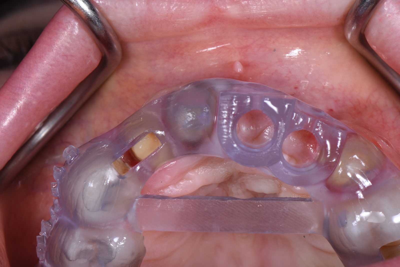The template seated in the mouth, occlusal view, both sleeves over the ridge