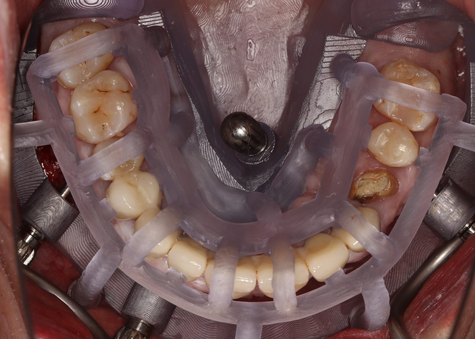 The implant guide stacked onto the seated base guide in the mouth