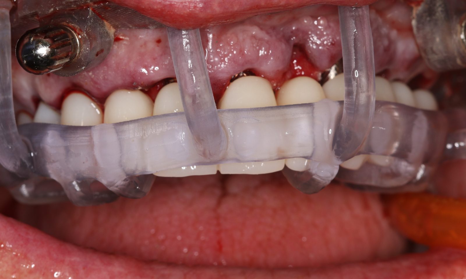 The guide in the mouth during surgery with the anterior sites prepared