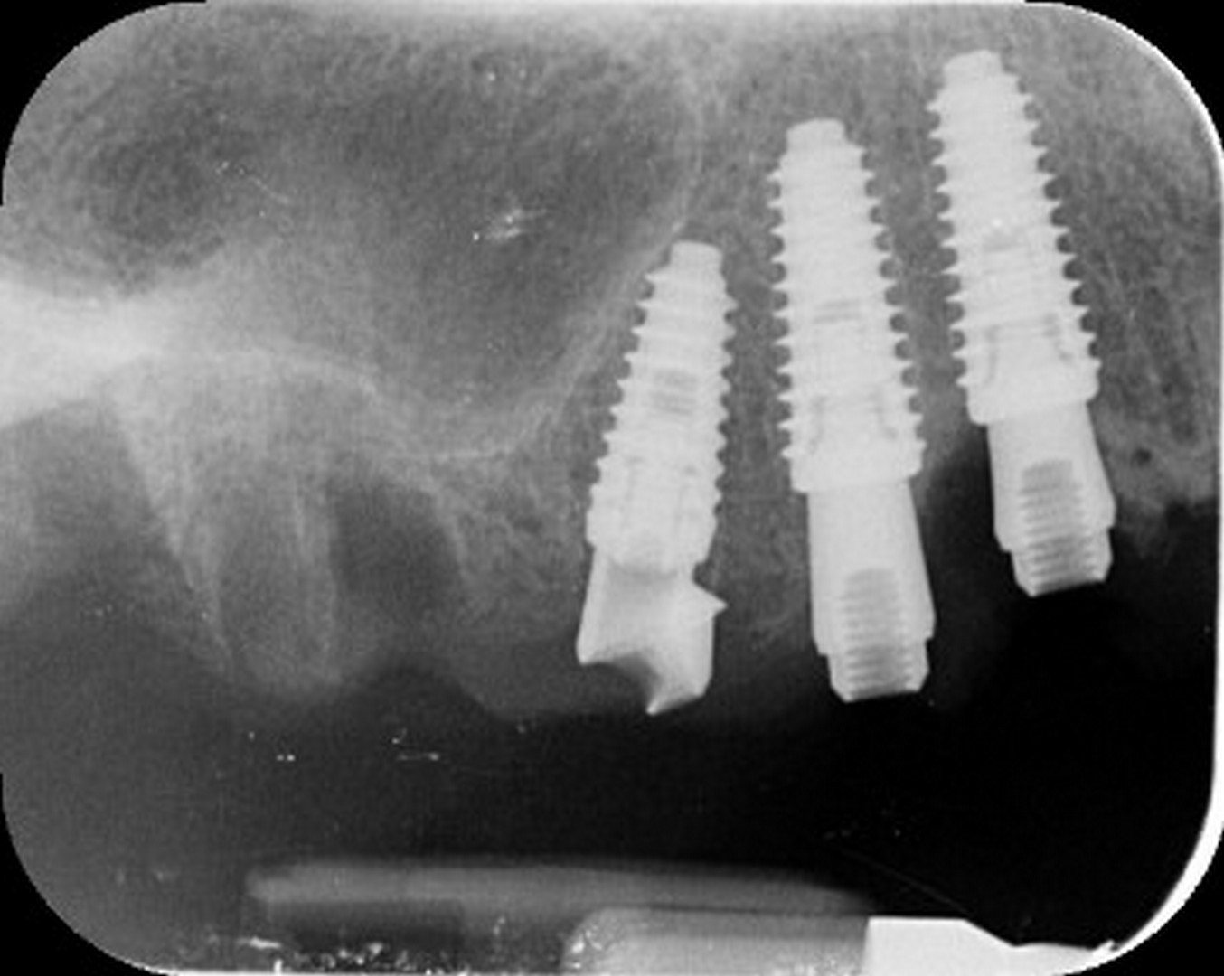 Post-operative intraoral periapical radiograph showing the three implants in position with multi-unit abutments seated