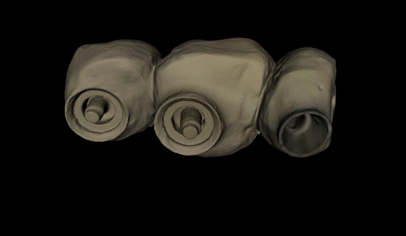 The three-unit screw-retained prosthetic design over the multi-unit abutment platforms