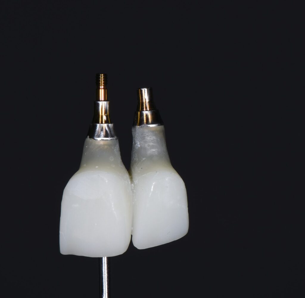 Two screw-retained provisional crowns on titanium bases, photographed off the mouth