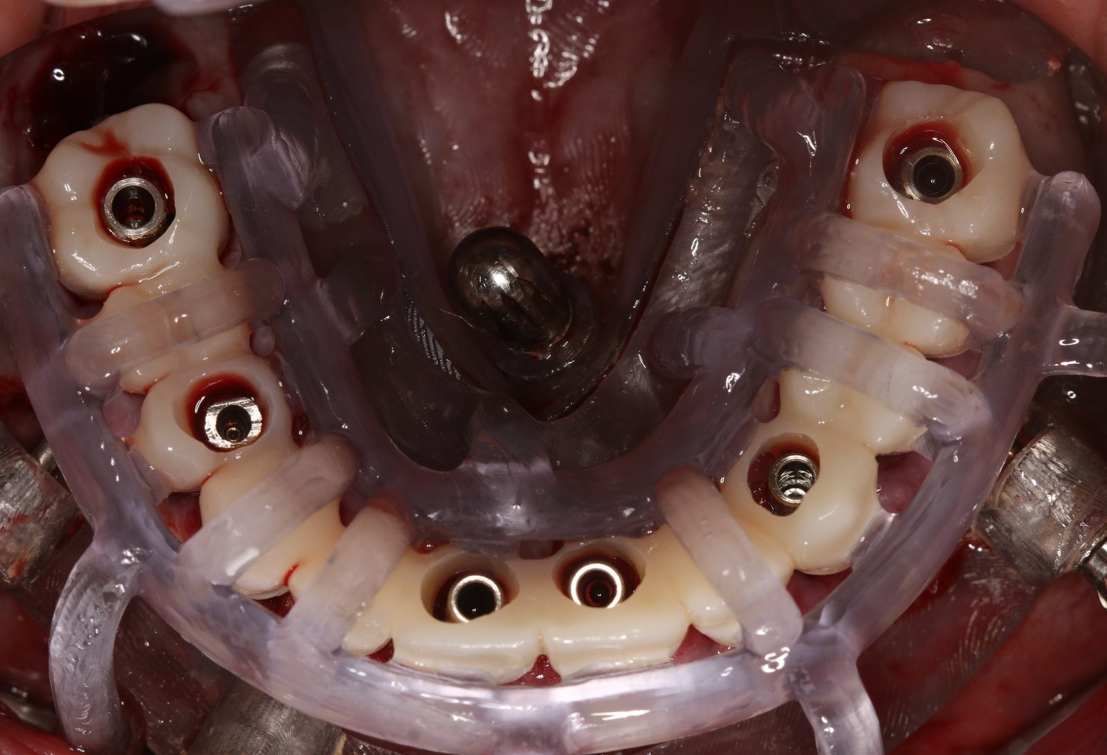 Occlusal view of the six implants and their abutments in place through the seated guide