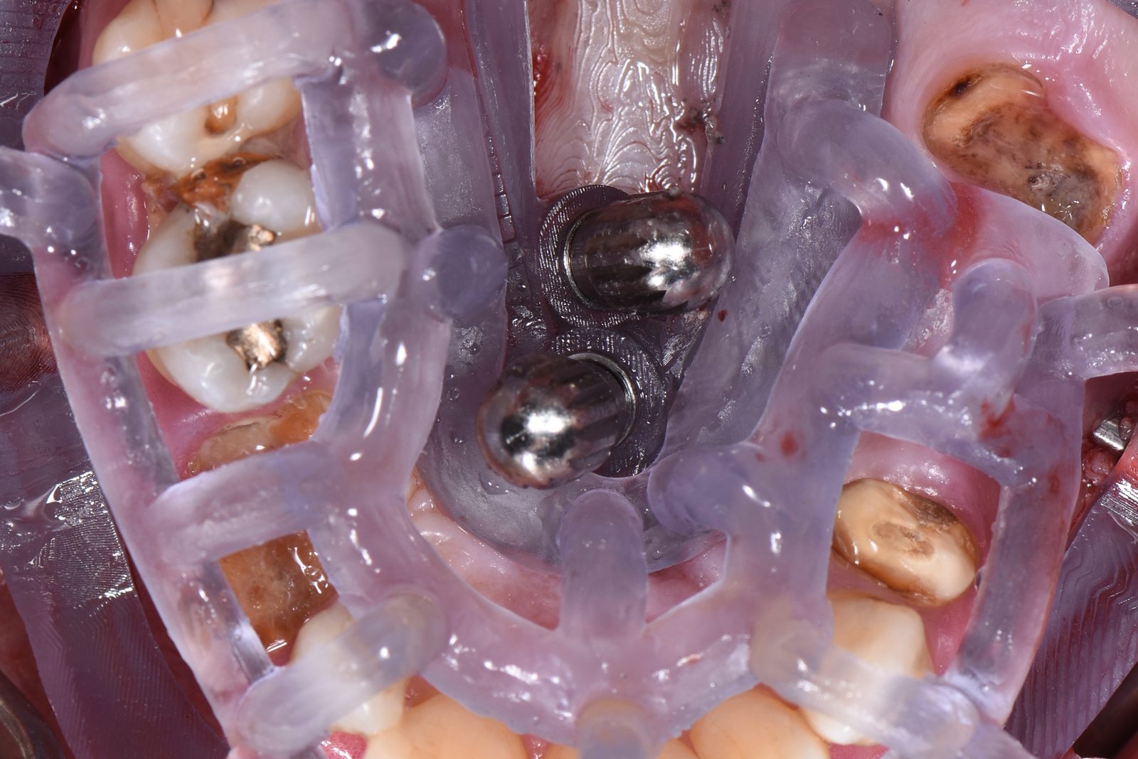 The stackable guide seated in the mouth over the remaining maxillary teeth, fixation pins in place