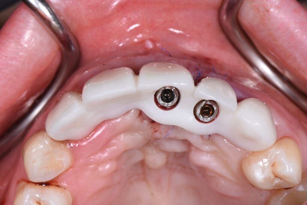 Occlusal view of the two screw-retained provisionals seated at 21 and 22 with the screw access channels visible