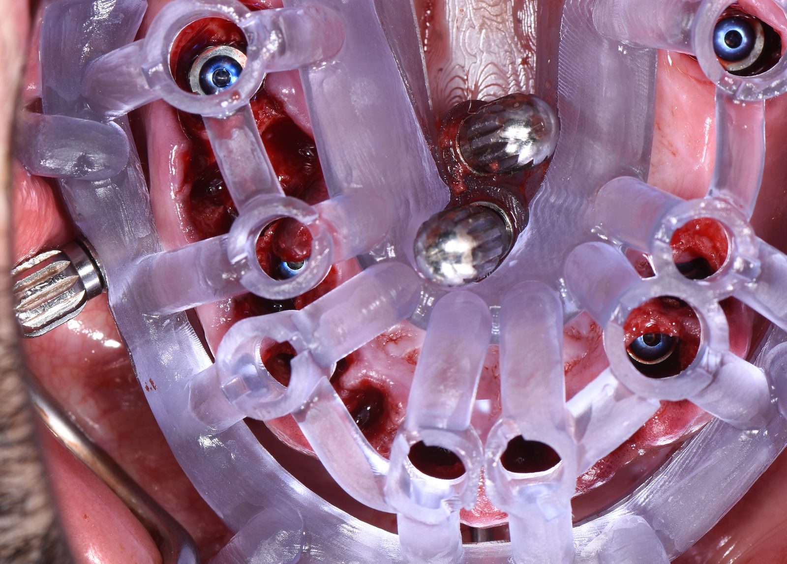 Occlusal view of the implants and multi-unit abutments in place through the seated guide