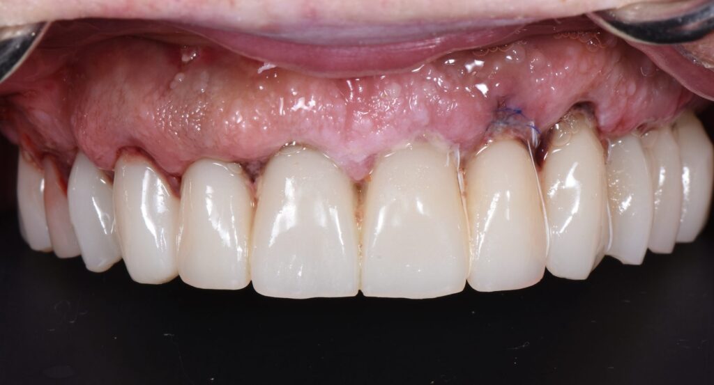 Frontal intraoral view of the fixed provisional seated across the upper arch on the day of surgery