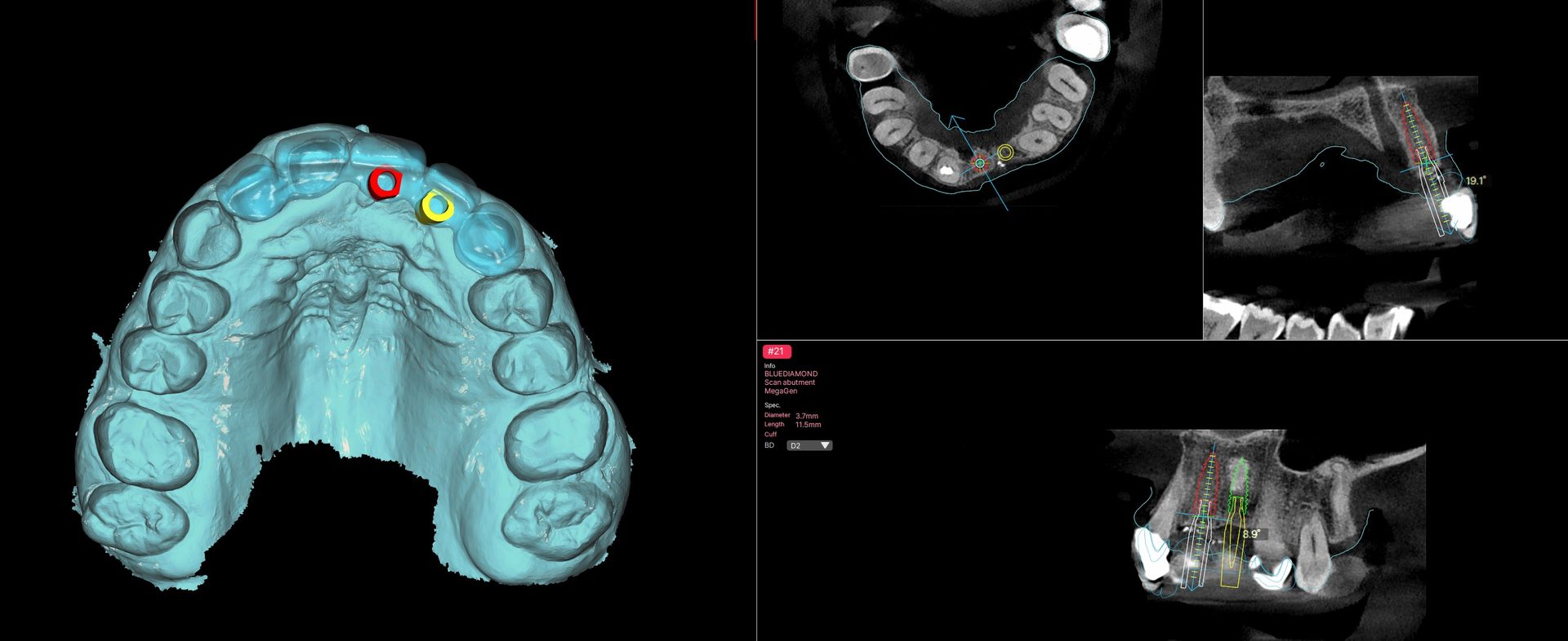 Planning screen for site 21 showing the implant position against the CBCT sections and the surface scan