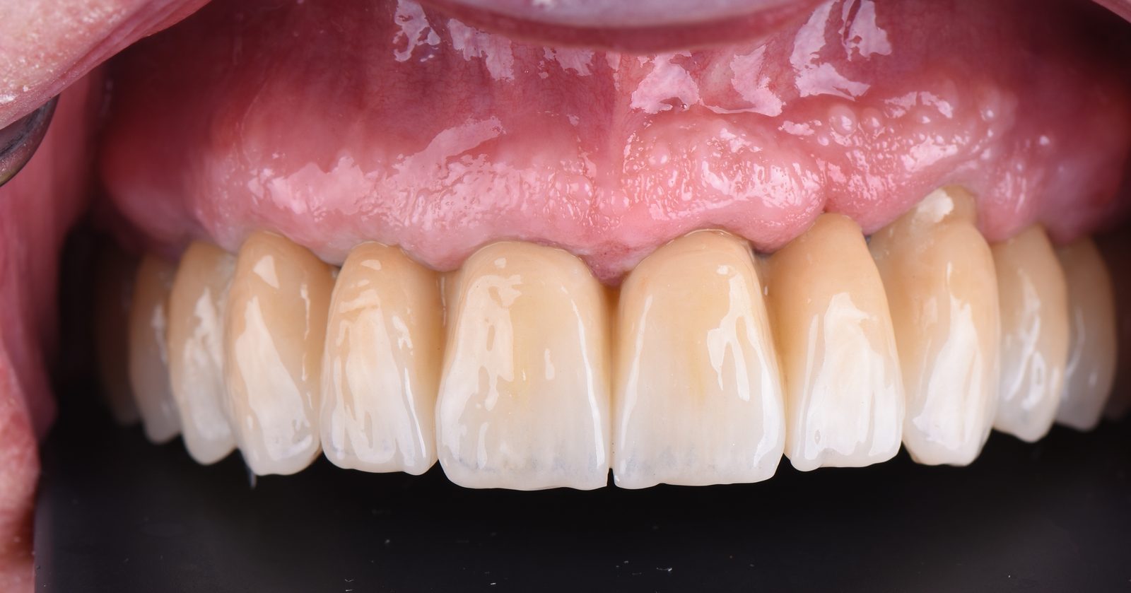 Frontal intraoral view of the definitive restoration seated across the upper arch