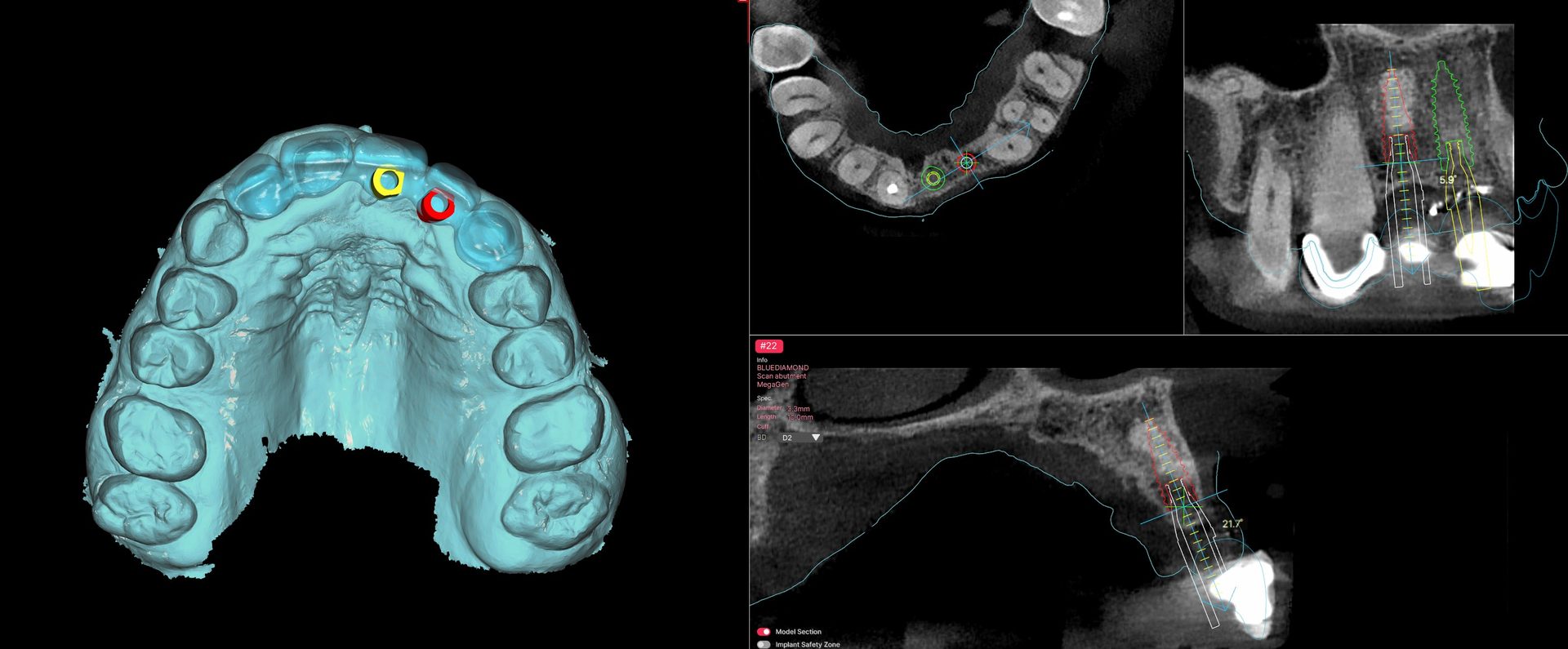 Planning screen for site 22 showing the implant position against the CBCT sections and the surface scan