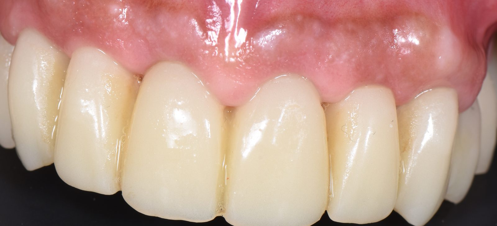Intraoral view of the fixed provisional seated across the upper arch
