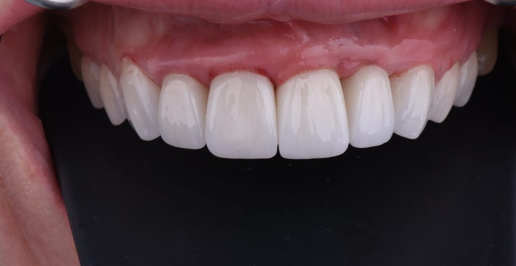 Frontal intraoral view of the restored anterior segment at 21 and 22