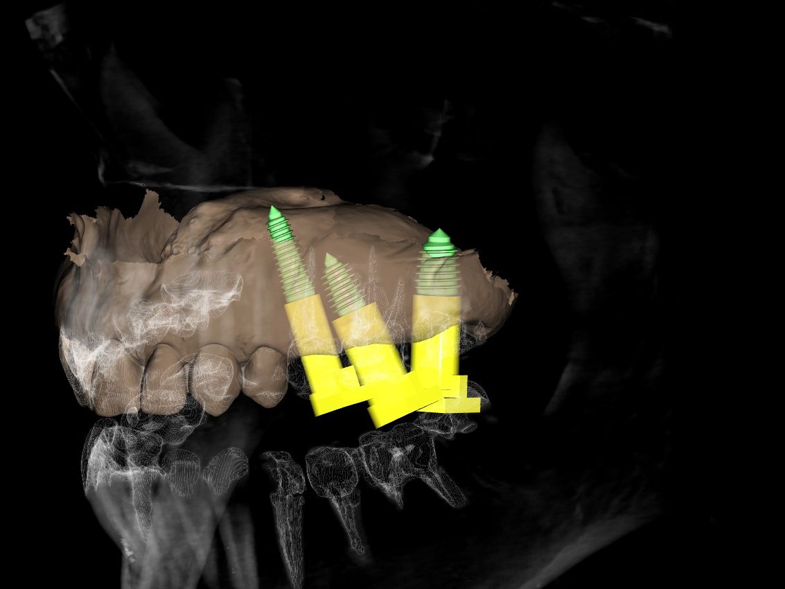 Three-dimensional reconstruction showing three tilted implants at 25, 26 and 27 with angulated multi-unit abutments