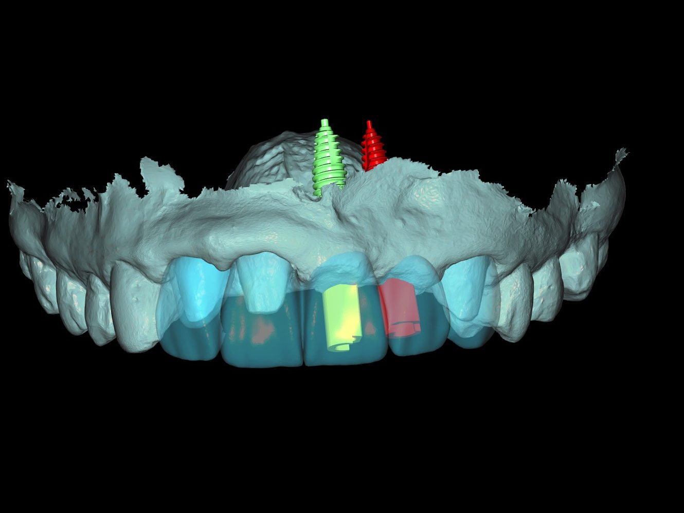 Three-dimensional plan of the anterior maxilla with two implants and their planned crowns at 21 and 22