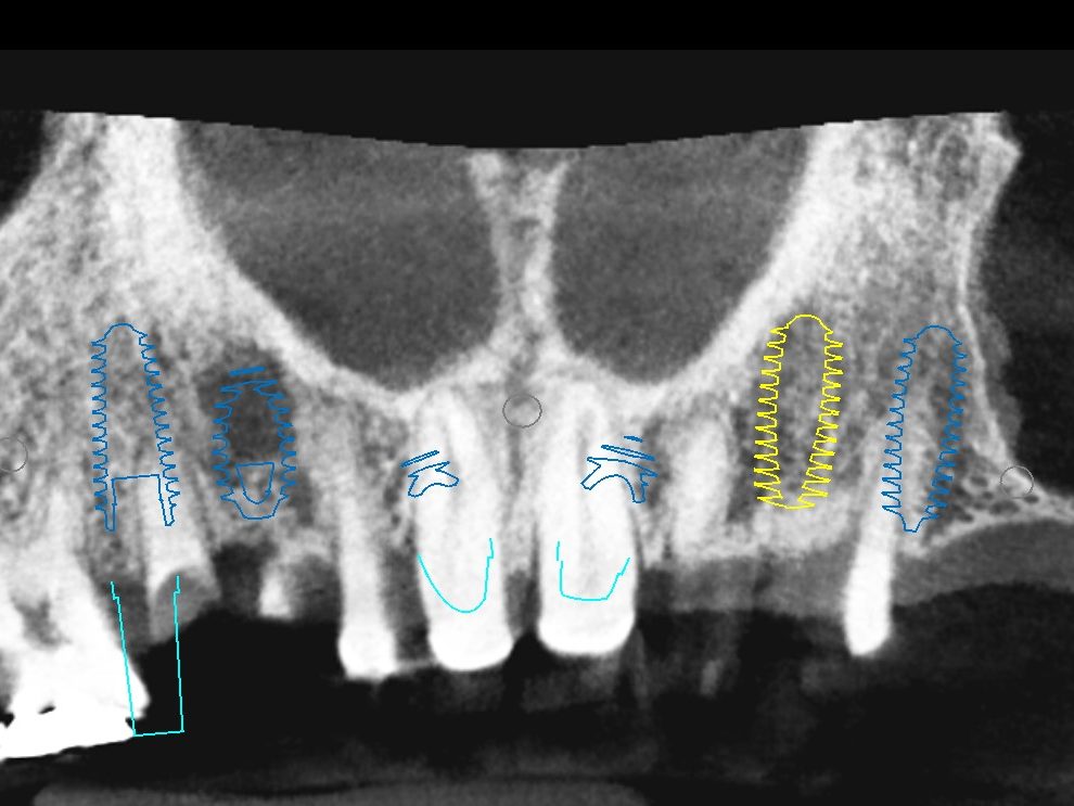 Panoramic CBCT reconstruction of a maxilla with eight implants planned across the arch