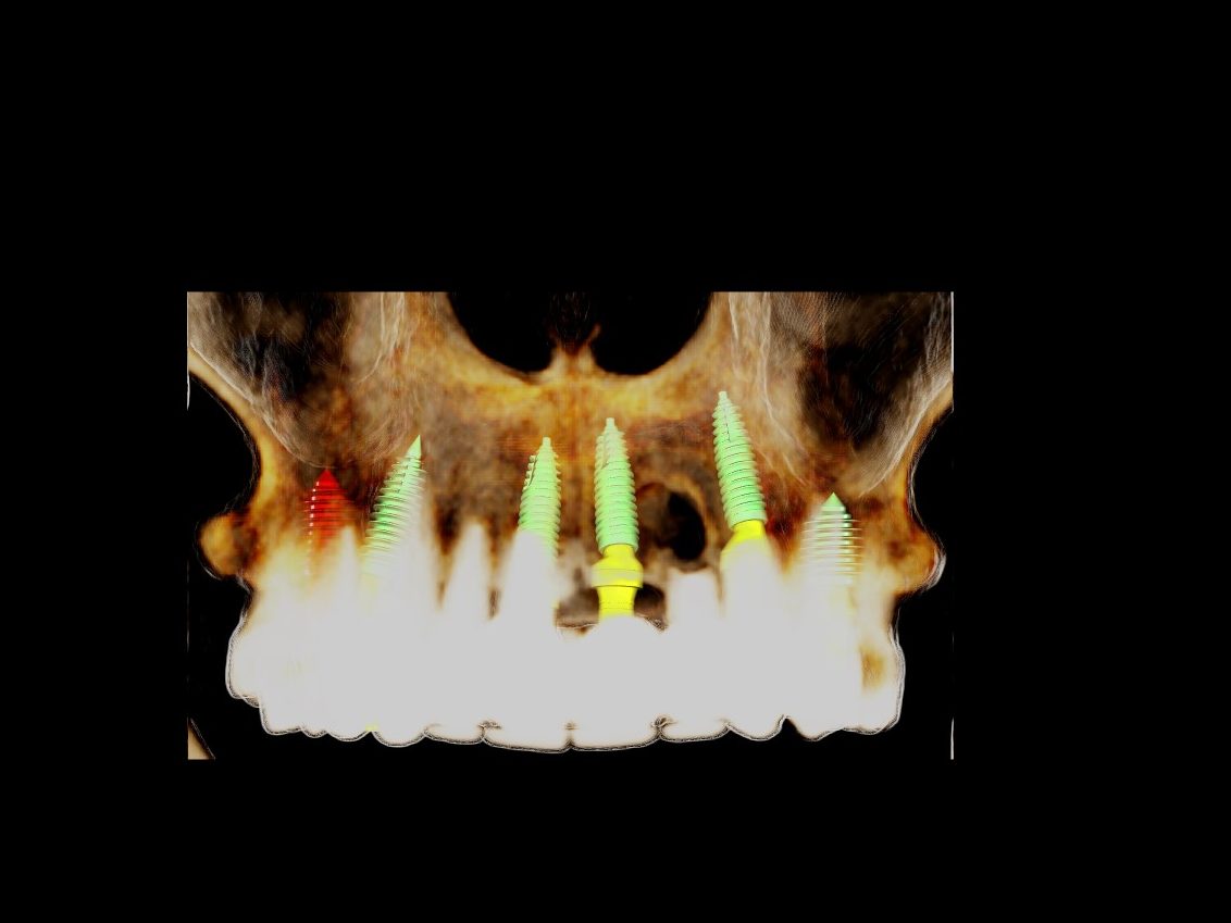 Three-dimensional SMOP plan of a maxilla with six implants and the planned provisional restoration