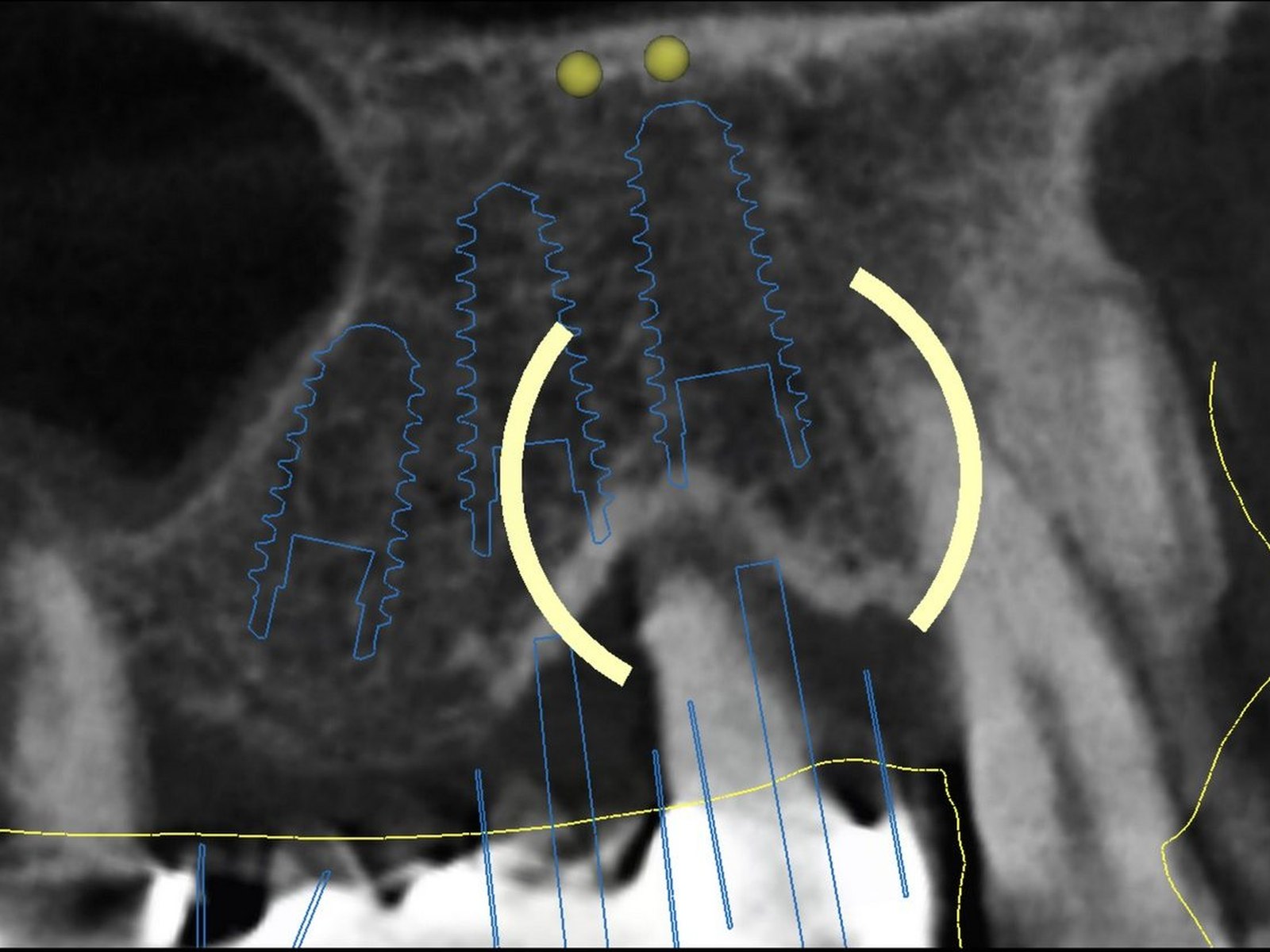CBCT cross-section with three implants planned at sites 13, 14 and 15, stopping short of the maxillary sinus floor