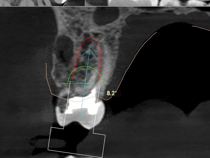 CBCT cross-section at site 16 with a 6.0 mm implant planned into the interradicular septum below the maxillary sinus